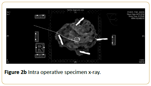 Specimen Orientation In Breast Conserving Surgery An Argument For Specimen Orientation In Breast Conserving Surgery An Argument For